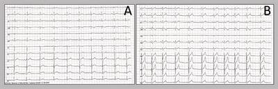 Case Report: Two Case Reports of Acute Myopericarditis After mRNA COVID-19 Vaccine